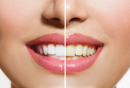 A split image showing a woman's smile, with one side having bright white teeth and the other side with yellowed teeth.